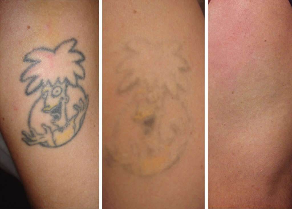 Tattoo-Removal-Progression-1024x736