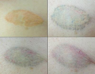 LASER OR PERMANENT TATTOO REMOVAL httpswhiteinkintreatmentLaserTattoo Removal8 LASER OR PERMANENT TATTOO REMOVAL Now with the latest laser  technology it is possible to remove permanent tattoos It is very safe for  the skin and