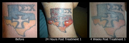 Laser Tattoo Removal and Blistering - Vanish Laser Tattoo Removal & Skin  Aesthetics
