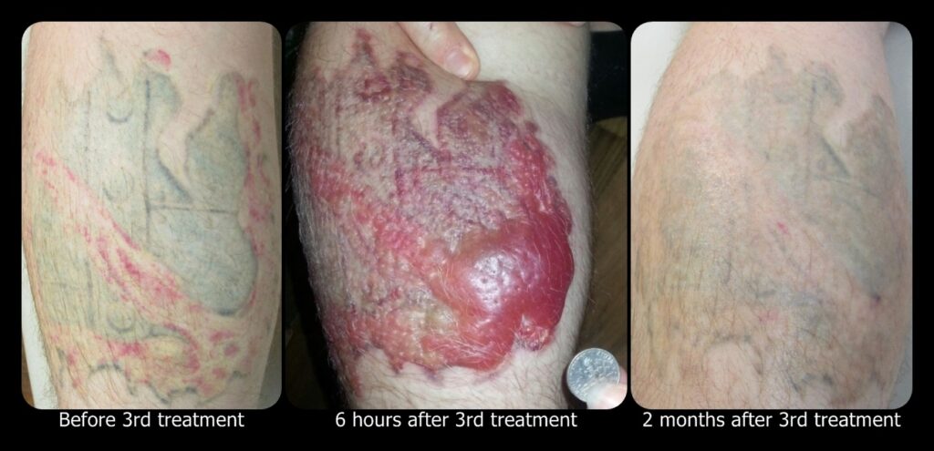 Photos of Blisters after Tattoo Removal
