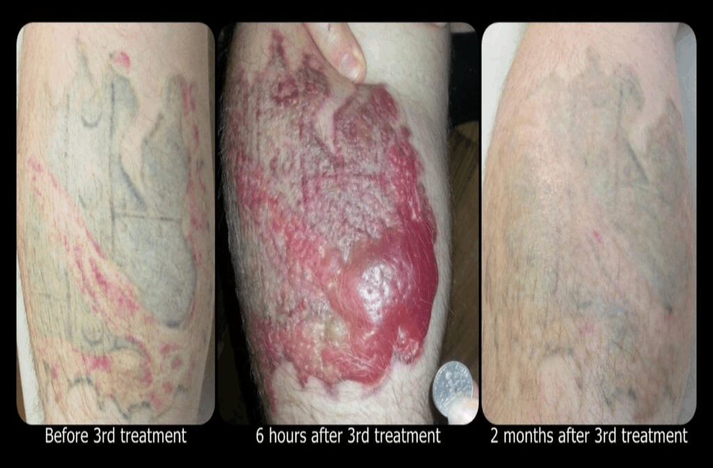 Blisters-after-Tattoo-Removal-1024x495