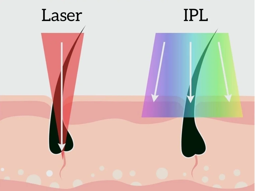 IPL-VS-Laser-Hair-Removal-1024x768