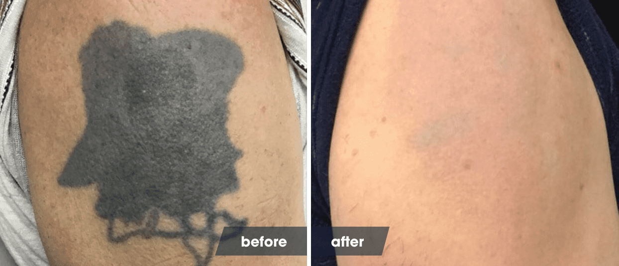 Tattoo-Removal-Before-and-After