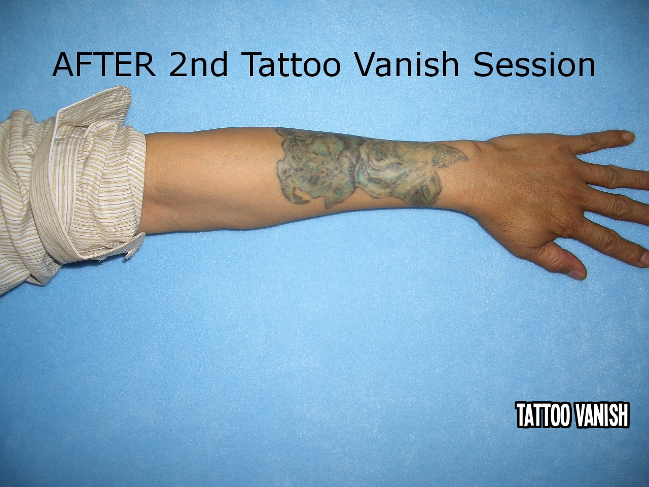 Tattoo Vanish