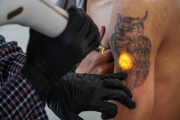 Denny Kurniawan from Hijrah Care is seen removing participants' tattoos using a laser machine during a free tattoo removal program on April 10, 2022, at Al Latiif Mosque, Bandung City, Indonesia. In the Holy Month of Ramadan, Hijrah Care in collaboration with the Al Latiif Mosque Family Council (DKM) held a free tattoo removal program with a total of approximately 40 participants. (Photo by Algi Febri Sugita/NurPhoto via Getty Images)