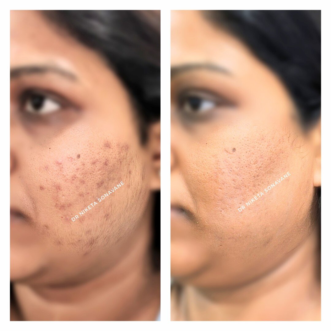 acne-treatment-in-Mumbai-pigmentation-treatment-in-Mumbai-before-after