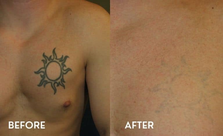 before-after-photos-laser-tattoo-removal