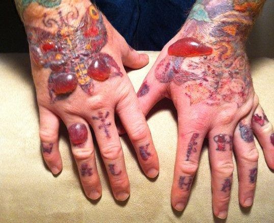 blisters-after-tattoo-removal-e1493831944579