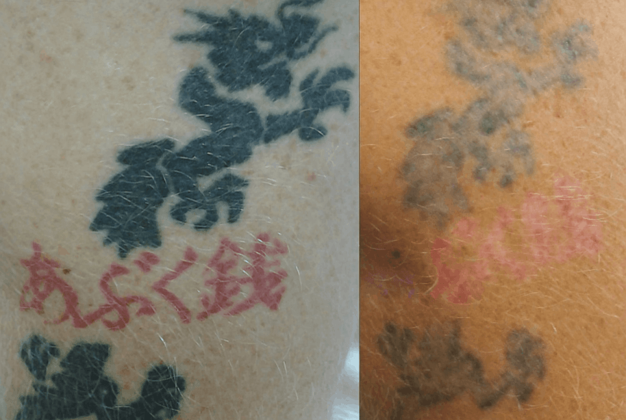 how-many-treatments-will-it-take-to-remove-my-tattoo