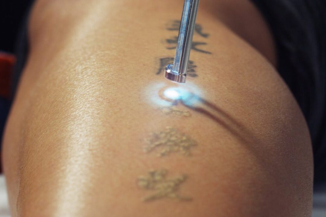 permanent-tattoo-removal