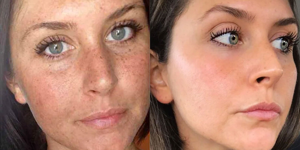 We offer many solutions to remove sun spots: Intense Pulsed Light, Chemical Peels, Microdermabrasion, Laser Therapy, Prescription Topical Creams and More. ????????????????????????????????????????????????????????????????????????????????????????????