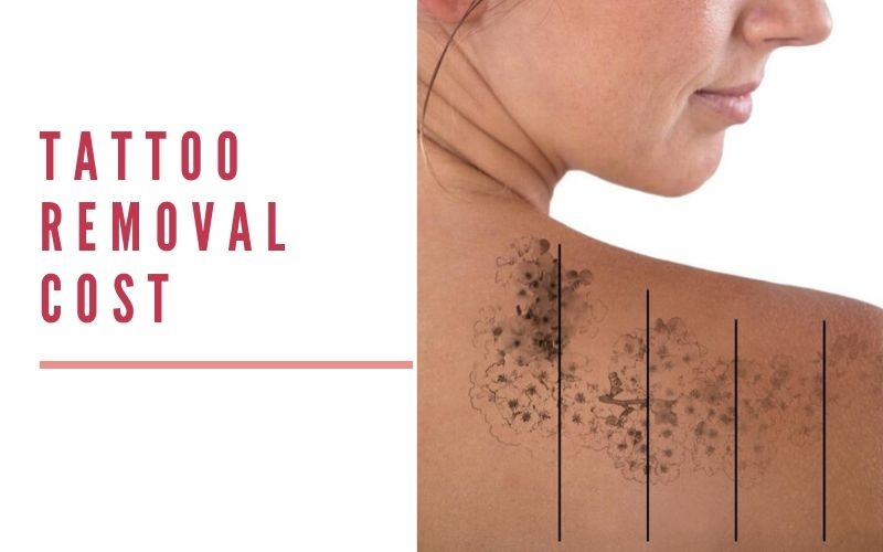 tatoo-removal-banner