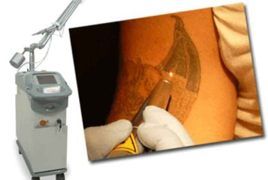 the-latest-and-greatest-in-laser-tattoo-removal