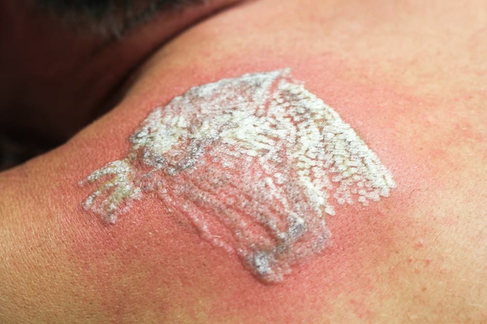 white-skin-after-laser-treatment