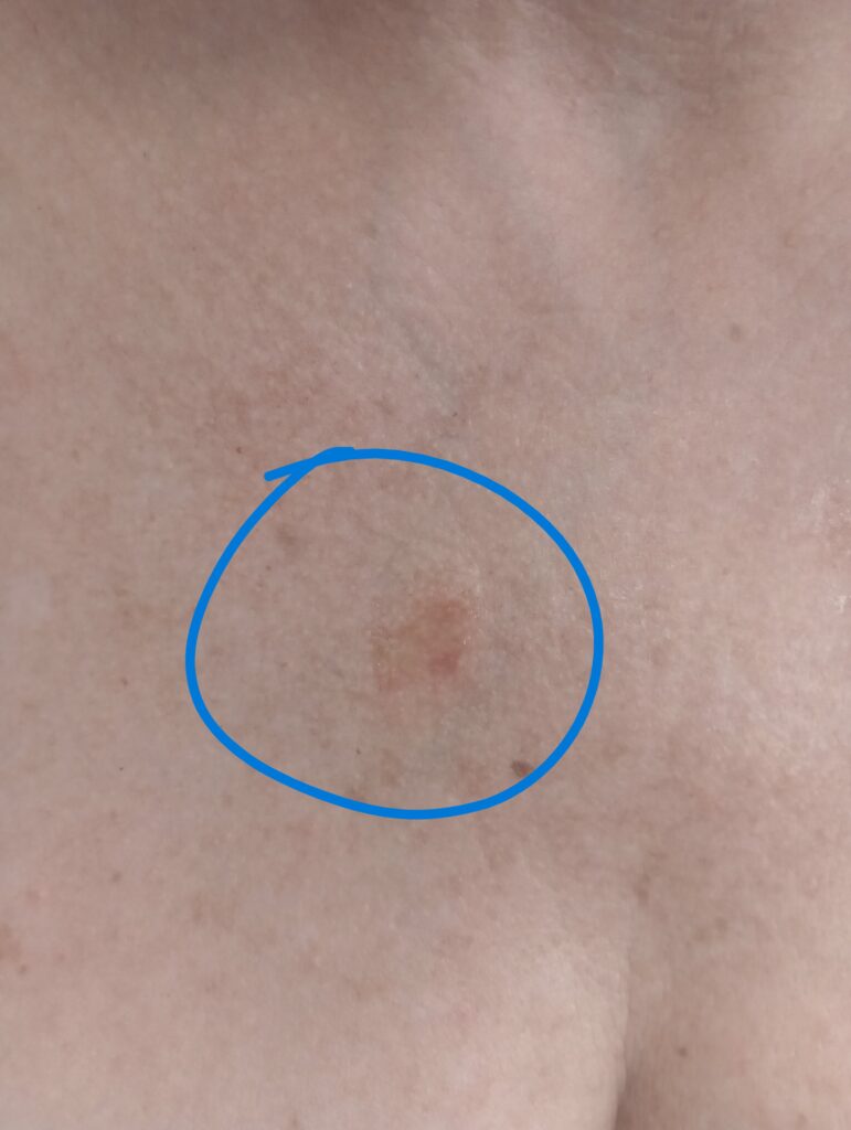 Redness immediately after 2nd IPL treatment. This is an expected and desirable response.
