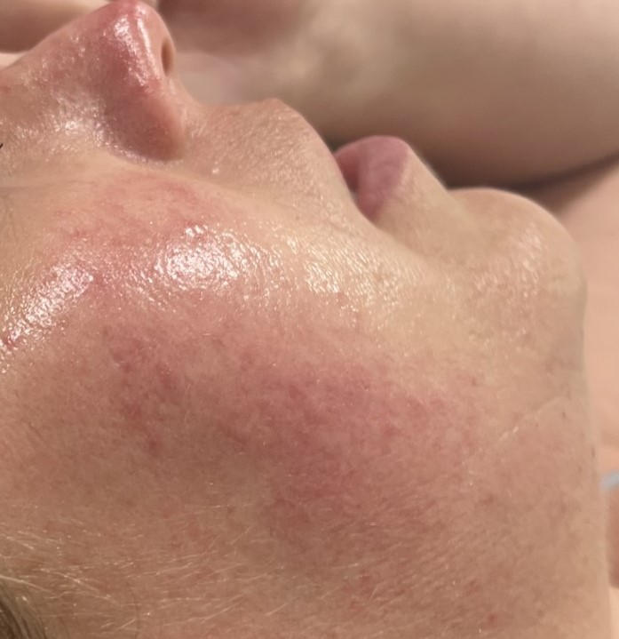 face with acne scars