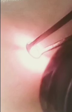 laser flash